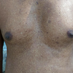 A local exhibiting signs of melanosis, during a field visit to Dhubri, Assam